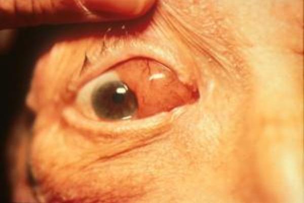 20121017120722-orbitlymphoma1