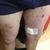 Shrapnel in his legs
