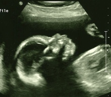 20121222185316-ultrasoundbabygirl