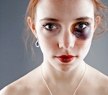 20130607152114-edited_black_eye_pic
