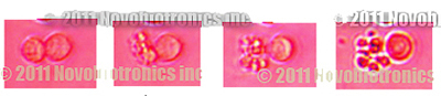 Ovarian Cancer Cells Shattered by Novobiotronics!